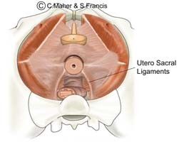 Diagram of a female pelvis indicating the ultero sacral ligaments